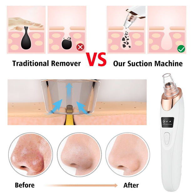 Electric Blackhead Remover - MagicSkinTech